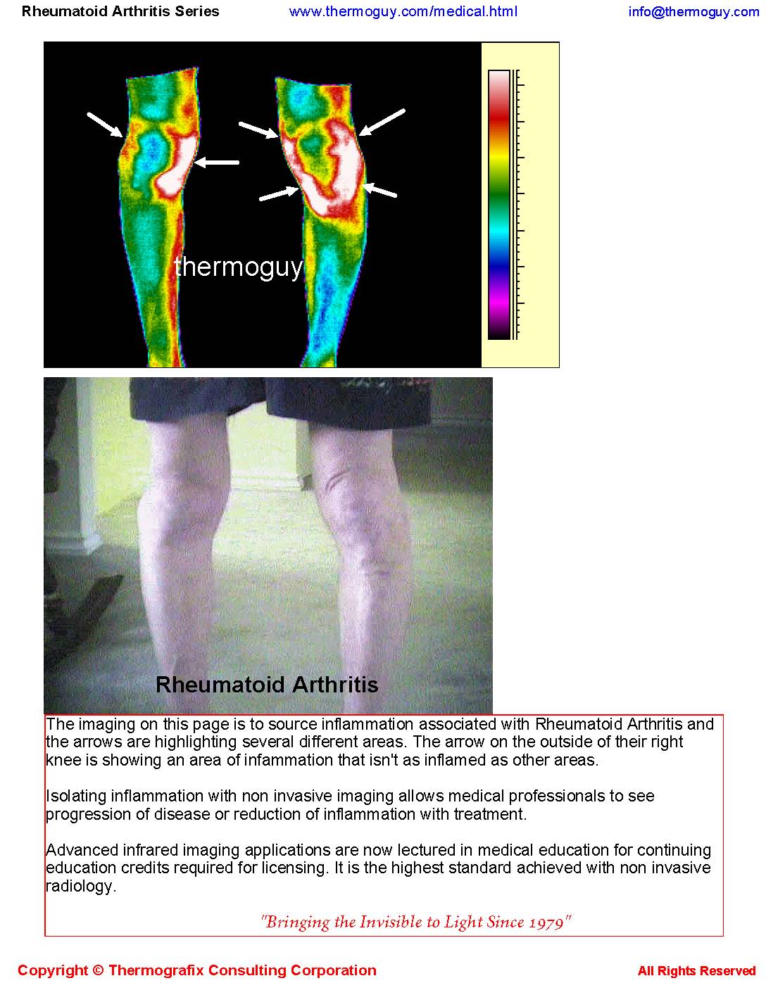 20120915-RHEUMATOID ARTHRITIS SERIES