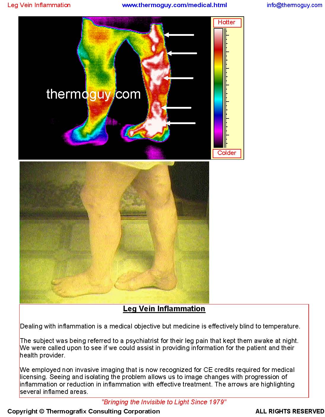 20121116-Leg Vein Inflammation