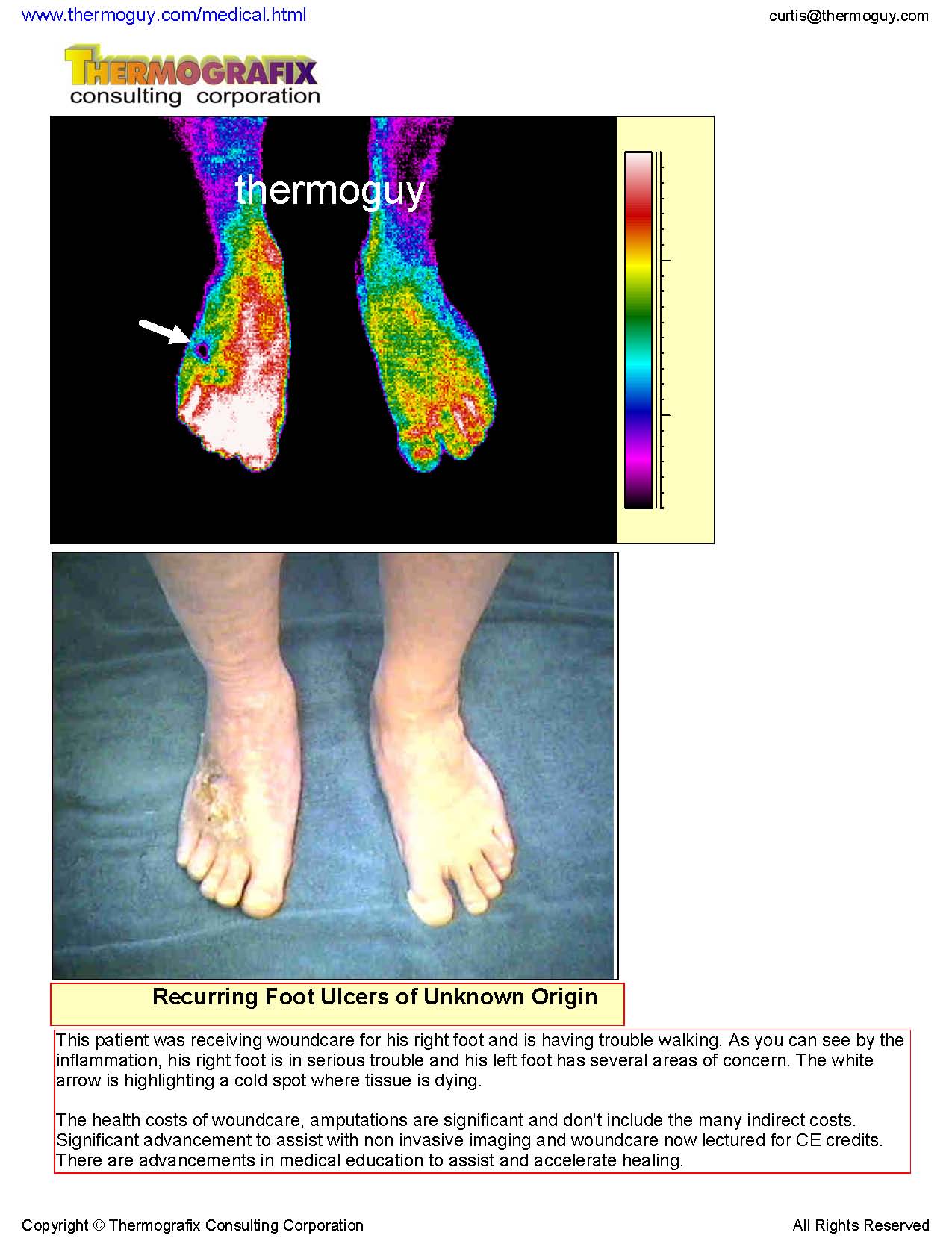 20130214-Recurring Foot Ulcers of Unknown Origin